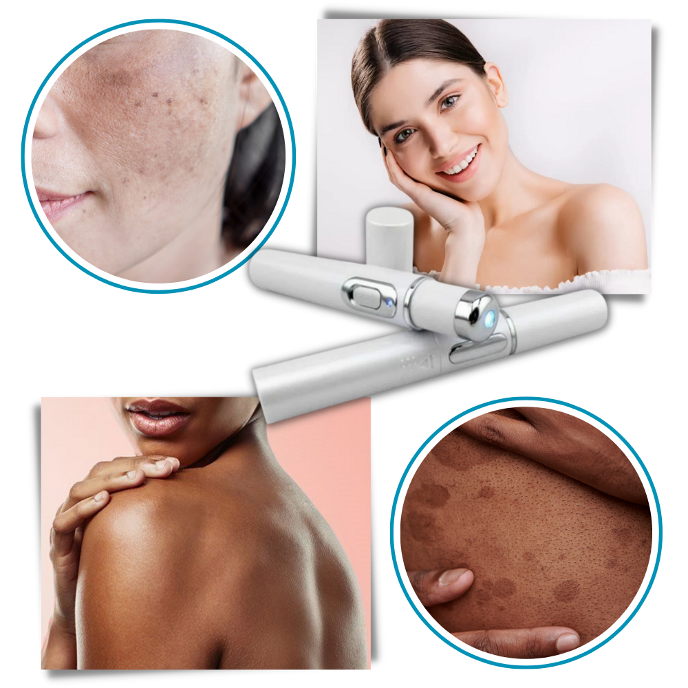  Dark Spot Remover Blue Laser Pen - Ozerty